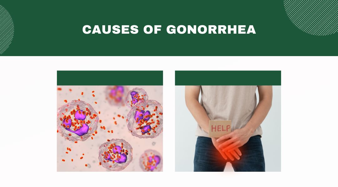 Get to Know Gonorrhea – EndHIV Today