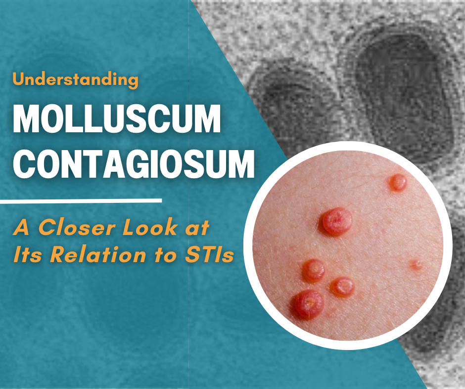 Understanding Molluscum Contagiosum A Closer Look at Its Relation to STIs